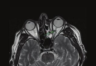 Rhino-orbito-cerebrális mucormycosis 6. ábra: 1 éves kontroll. A n. opticus magasságában a kóros te - rime jelentősen regre - diált.