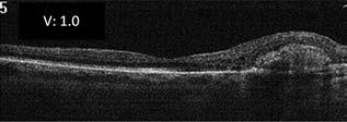 Teljes körű kivizsgálás más betegséget nem mutatott, a HLA-A29*02 pozitivitás alátámasztotta a madársörét chorioreti no pathia diagnózisát. Jobb szem OCT leképezése a 3.