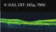 június, a dexamethasone intravitreális implantátum előtt CRT: 248 μ, TMV: 10,8 mm 3 CRT: 330 μ, TMV: 13,2 mm 3 3. B ábra: 3.