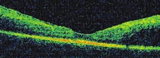 Harmadik generációs Zeiss OCT-készülékkel végzett mérések alapján azt találták, hogy, a retina legkülső, erősen reflektív sávjának