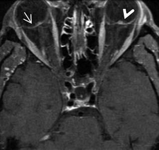 az int raarterialis és intravénás throm bolysis hatása azonban megkérdőjelezhető (9, 12). Jellemző a fun duskép: a retina igen halvány, és a macula vörös a környező neuro retina ödémája miatt.