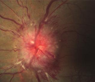 vascularis attenuáció és a RPE (retinalis pig mentepithelium) atro - phiája követi. Prognózisa rosszabb, mint a MEWDS-é.