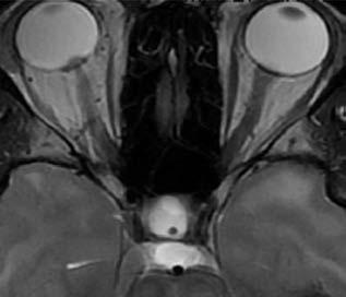 Az emelkedett intra - cranialis nyomást okozhatja agydaganat, carcinomatosus és infekciós meningitis, amely elzáródásos hyd - rocephalusszal társulhat (1. ábra) (48).