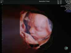 000 nőt fogunk - már a terhességük előtt, és a terhességük alatt - megvizsgálni. Többek között ezt vizsgáljuk: Készítünk külön 3D-s ultrahangos felvételeket!