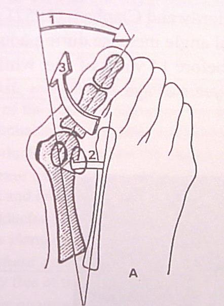 Hallux valgus 1. Hallux lateral felé történő deviációja 2.