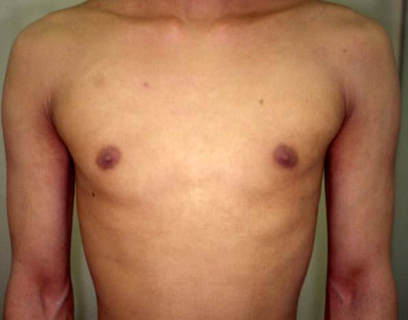 Fig. 1:(Color) 1a: 22-year-old man suffering from severe atopic dermatitis since childhood before