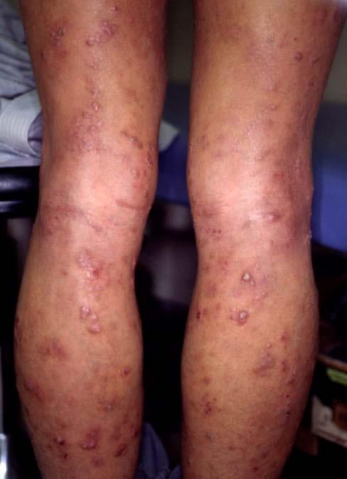 1b: He was able to maintain a cured state for 4 months by reducing the number of mites in all