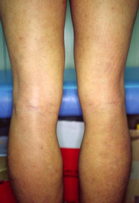 2: (Color) 2a: 29-year-old man suffering from severe atopic dermatitis since childhood before 