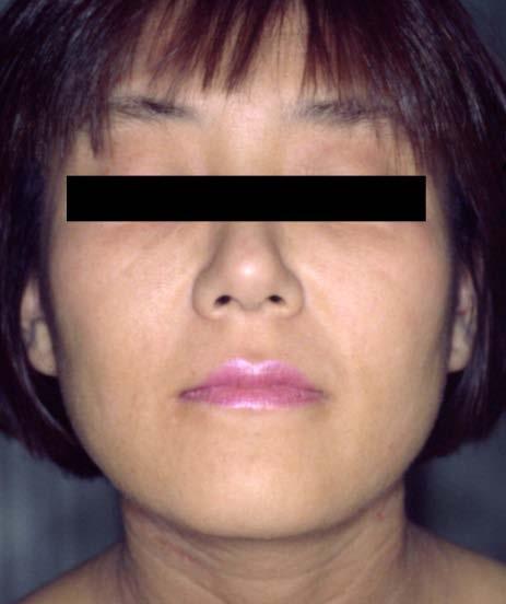 3: (Color) 3a: Face of a 27-year-old woman suffering from severe atopic dermatitis before receiving