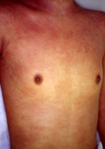 3b: She was able to maintain a cured state for 2 years and 11 months by reducing the number of mites