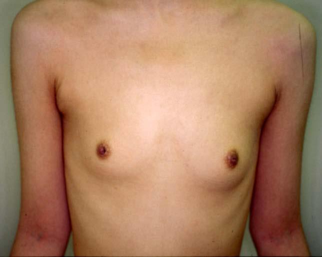 4: (Color) 4a: 23-year-old woman suffering from severe atopic dermatitis for more than 10 years