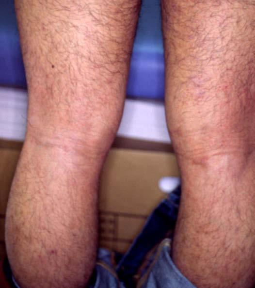5: (Color) 5a: 18-year-old man suffering from severe atopic dermatitis since 3 years before