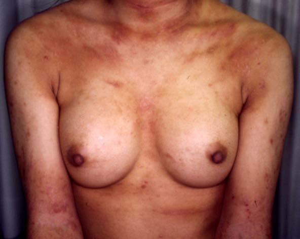 5b: He was able to maintain a cured state for a year and a half by reducing the number of mites in