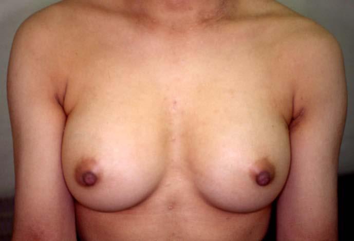 6: (Color) 6a: 19-year-old woman suffering from severe atopic dermatitis since 5 years before 