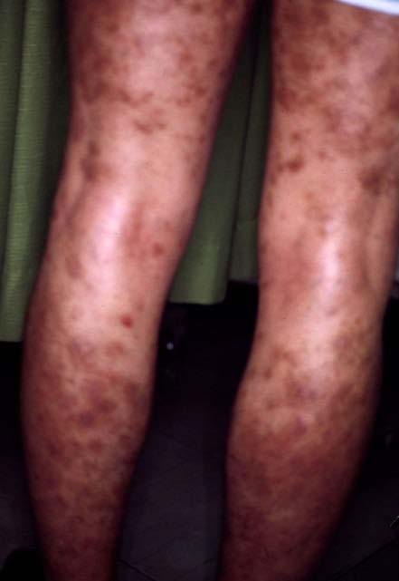 Mite Fauna Investigation Followed by Scientifically Reducing House Dust Mite Less than 50/M 2 per 20 Seconds of Aspiration Can Cure Severe Intractable Atopic Dermatitis for Years to Come 27 7a Fig.