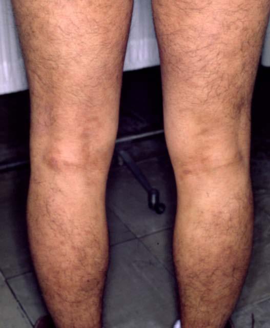 7b: He was able to maintain a cured state for a year and 10 months by reducing the number of mites in all household furniture to less than 50/m 2 per 20 seconds of aspiration. Fig.