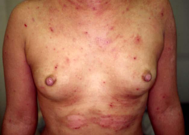 8b: She was able to maintain a cured state for 3 months by reducing the number of mites in all household furniture to less than 50/m 2 per 20 seconds of aspiration.