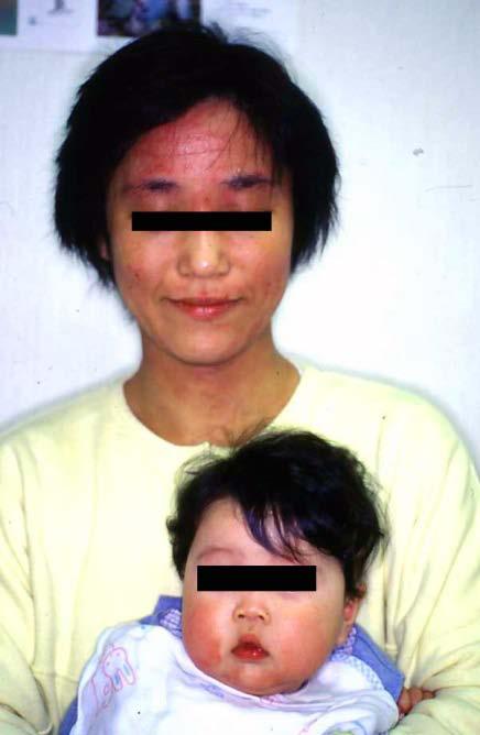 Mite Fauna Investigation Followed by Scientifically Reducing House Dust Mite Less than 50/M 2 per 20 Seconds of Aspiration Can Cure Severe Intractable Atopic Dermatitis for Years to Come 28 In China,