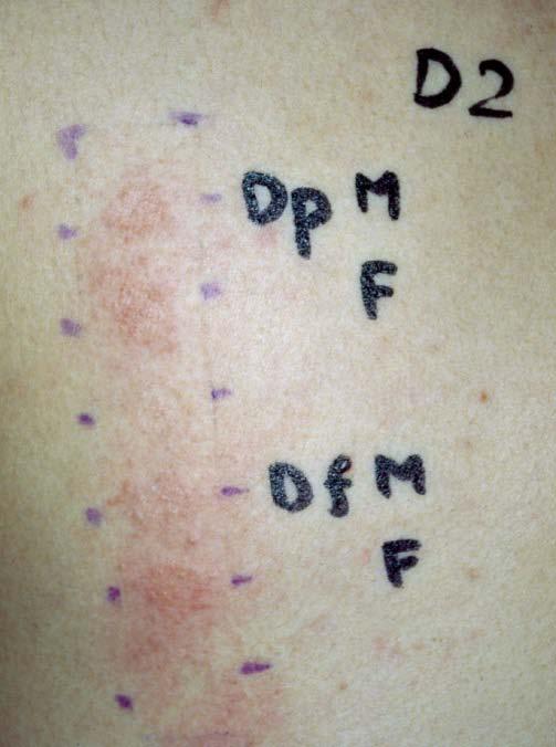 Mite Fauna Investigation Followed by Scientifically Reducing House Dust Mite Less than 50/M 2 per 20 Seconds of Aspiration Can Cure Severe Intractable Atopic Dermatitis for Years to Come 31 11a Fig.