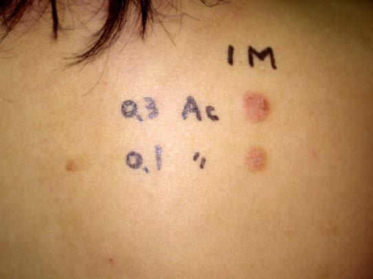 Mite Fauna Investigation Followed by Scientifically Reducing House Dust Mite Less than 50/M 2 per 20 Seconds of Aspiration Can Cure Severe Intractable Atopic Dermatitis for Years to Come 32 12a 12b