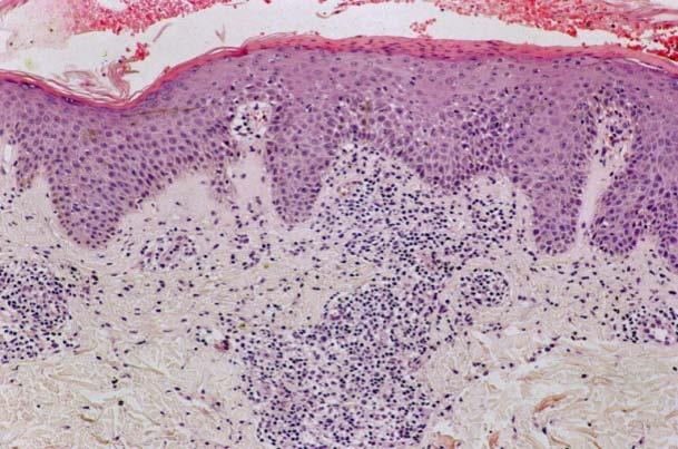 The α-acaridial contained in Tp is a primary sensitizer and produced erythema with infiltration for more than a month (12a)and 6 months at the longest when it was patch tested at 0.1% - 0.