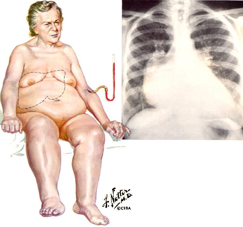 Normotenzív akut szívelégtelenség RR normális a krónikus SZE tüneteinek progresszív, napokon át tartó romlása pulmonalis és szisztémás pangás jelei egyformán jelen lehetnek a bal kamrai