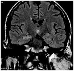 Ezeken a felvételeken a szürkeállomány kis területet érintő megvastagodása, a szürke és fehérállományi határ elmosott volta hívja fel a figyelmet a corticalis dysgenezisekre.