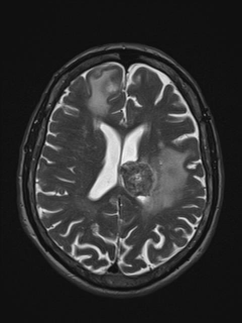 MR felvételek is készültek T2, T1, T1 k.a., FLAIR illetve diffúzió súlyozással. Amelyeken szintén számos metastasis írható le. 11.