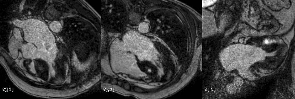 Vágó Hajnalka 4. ábra Hypertrophiás cardiomyopathia hossztengelyi késõi típusú kontraszthalmozásos felvételei.