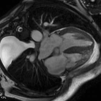 Mágneses rezonancia vizsgálat a szívelégtelenség pontosabb diagnosztikájában CMR technikával (32).