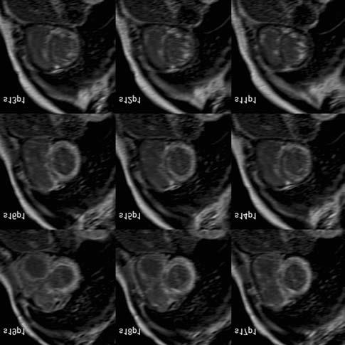 Ahogy a myocardialis vasterhelés fokozódik, az ejekciós frakció progresszíven csökken, valamennyi szívelégtelen betegnek <20 ms a T2* értéke.