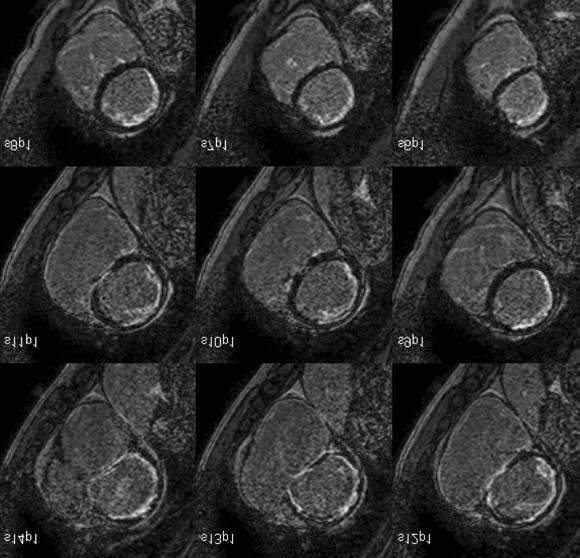 Késõi típusú kontraszthalmozással a basalis inferolateralis segmentum gyakran érintett, típusosan a subendocardium megkímélt.