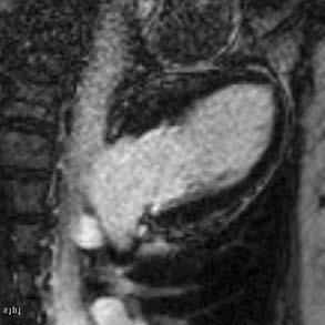 A típusos esetben stressz indukálta Tako Tsubocardioymopathia esetén a csúcs ballonszerû tágulata és falmozgászavara mellett, mely összességében myocardialis infarctust utánozhat, típusosan nincs