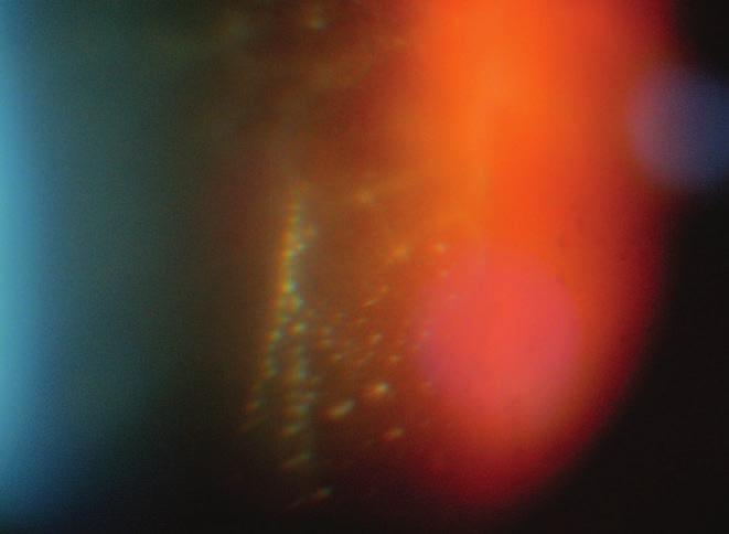 herpes virus retinitis caused by primary infection immunrendszerű szervezetben is kifejlődhet.