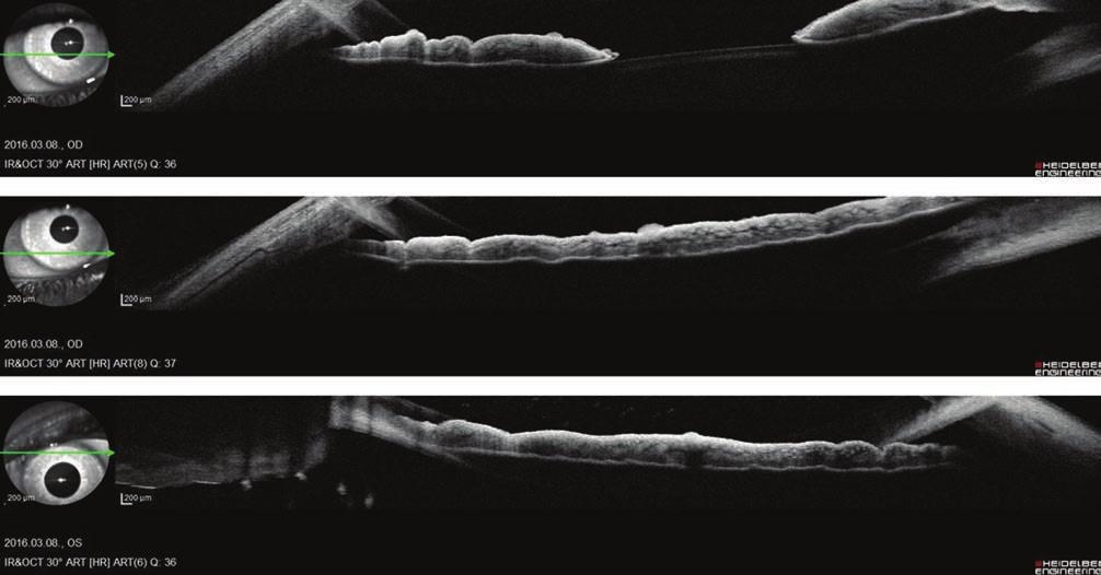 Recklinghausen-kórban szenvedő betegek szemészeti gondozása 7. ábra: lisch-csomók anterior szegment oct-képe sában is.