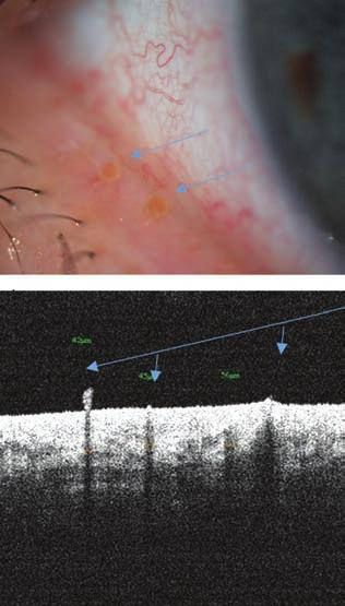 cataract and dry eye Index: OSDI) (39), amelynek magyar nyelvű változata igazoltan megbízható hazai mintán (48).