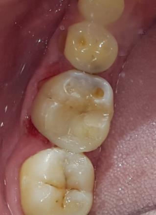 dentin előkészítés Nyaki kompozit tömés