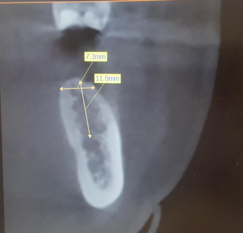 implantátum Implantálást végző orvos: Dr: Csányi Zsuzsanna