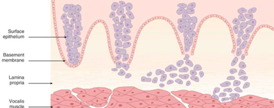 VI.c. Laphám carcinoma Epidemiologia Az összes rosszindulatú gégetumor 95%-a A rosszindulatú tumorok 1%-a (ffi) illetve 0,3%-a (nő) Etiologia >95% dohányzó a glotticus lokalizáció estén