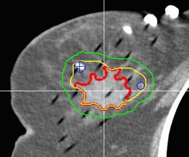 The treatment of prostate cancer with high dose rate (HDR) brachytherapy This method, called HDR brachytherapy, is used in the treatment of localized or locally advanced non-metastatic prostate
