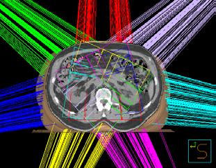 Intensity-Modulated Radiation Therapy (IMRT) IMRT is a more conformal external irradiation method compared to conventional techniques like 3D-CRT.