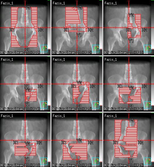 The shape and dose of each field are calculated by optimizing algorithm of treatment planning software (inverse planning).