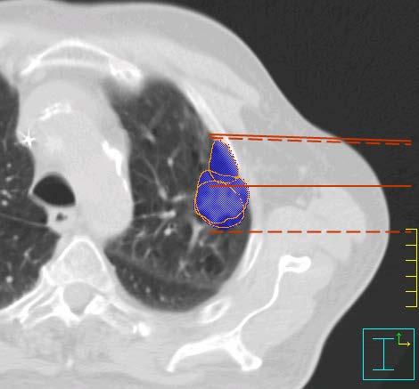 Respiration-Gated Radiation Therapy This method was developed to improve geometrical accuracy of thoracic external irradiation by eliminating artefacts caused by