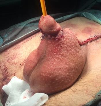 TUMORSZERŰ ELVÁLTOZÁSOK Tancho nodulus (paraffin granuloma,