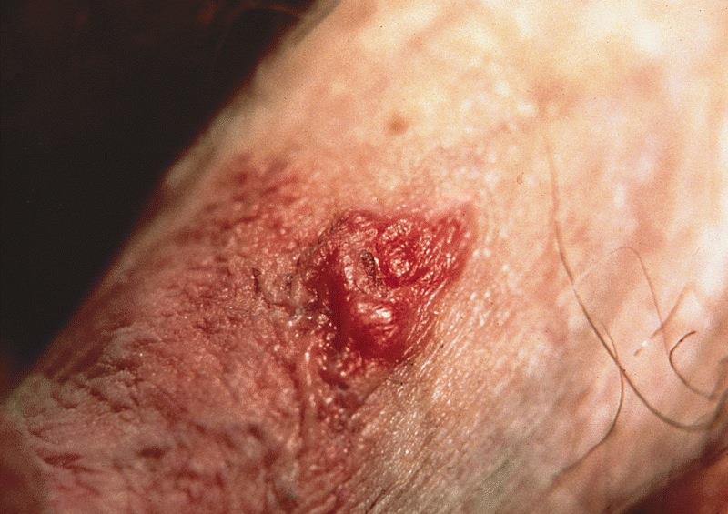 PREMALIGNUS LÉZIÓK Bowenoid papulosis: 30-40 évesekben, főleg penis corpusan.