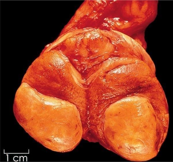 II. SEX-CORD-STROMALIS TUMOROK 4%-a a testicularis daganatoknak Leydig, Sertoli, granulosa,