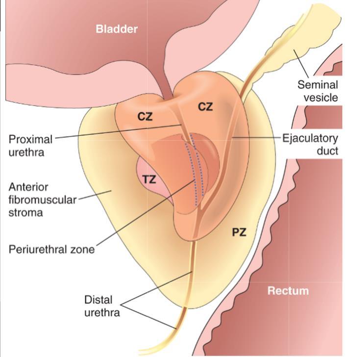 Hyperplasia: