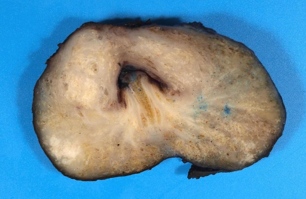 A PROSTATA