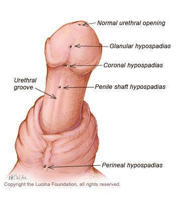 hypospadiasis: a húgycső a