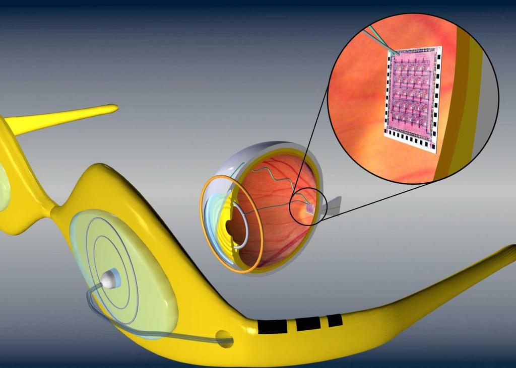 (Bio)orvosi alkalmazhatóság Implantált gyógyszer adagolók